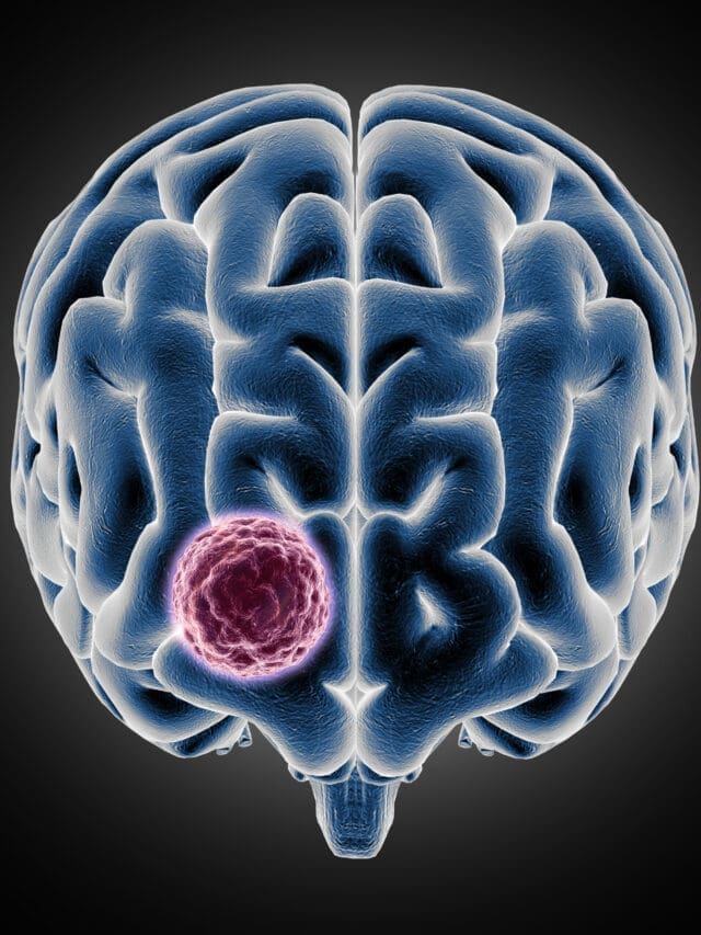 SILENT BRAIN TUMOR : YEARS WITHOUT NOTICE?